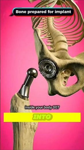 Hip Replacement Surgery Explained Step by Step | Artificial Hip Joints Restore Pain-Free Movement