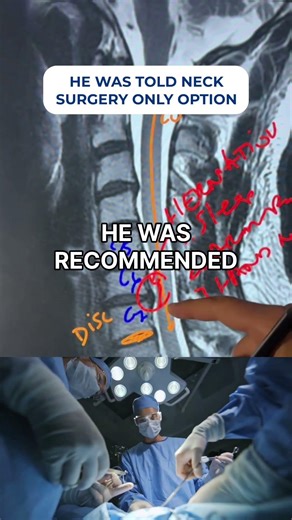 Severe C6-C7 Disc Herniation Relieved Without Surgery | Spinal Decompression Success #NeckPain