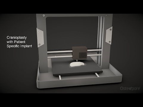 Cranioplasty with Patient Specific Implant