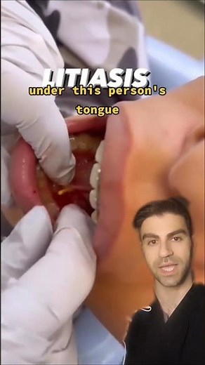 Salivary Gland Stone Removal