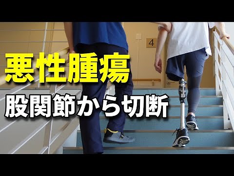 A childhood cancer survivor with a disarticulated hip