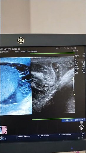 Inguino-scrotal Hernia with Pyocele. Ultrasound