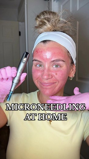 Microneedling Step by Step: Results and Tips
