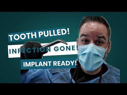Tooth Extraction & Dental Implant Prep with Dr. Martinez!