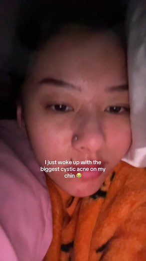 Cystic Acne on Chin: Understanding the Pain and Solutions