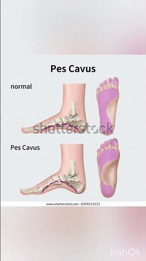Pes Cavus (High Arched Foot) #deformitycorrection #healthylifestyle #fitness