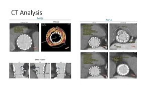Management of PVL after TAVI