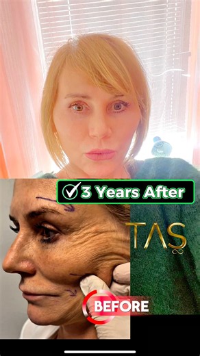 Full story of a scarless facelift from beginning to 3 years after #facelift #faceliftexpert