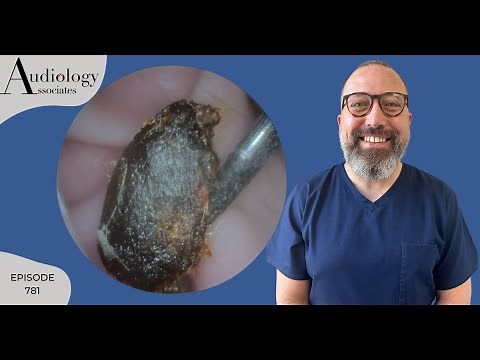 CURETTAGE EAR WAX REMOVAL/SKIN REMOVAL REVEALING A FALSE FUNDUS - EP781