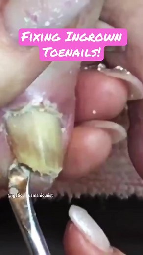 Ingrown toenails can be helped with a pedicure! #ingrown_toenail #pedicure #diypedicure #toenails #howtopedicure #pedicuretools #pedicuretraining #meticulousmanicurist | The Meticulous Manicurist Nail Tutorials