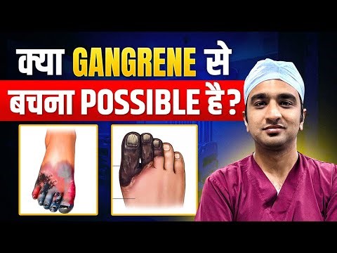 Gangrene: Early Signs, Causes & Prevention | Gangrene Treatment Without Surgery
