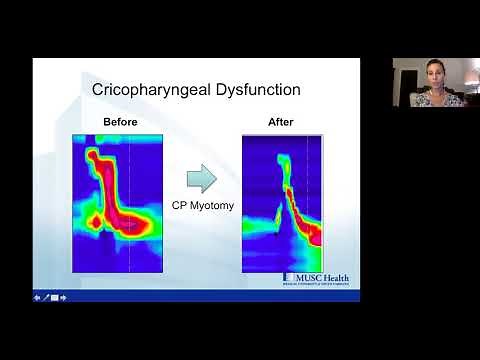 TFV Webinar - 8.28.18 - "Practical Pharyngeal and Esophageal High Resolution Manometry"
