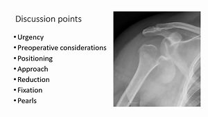 Case Presentation: Proximal Humerus Fracture After a Fall