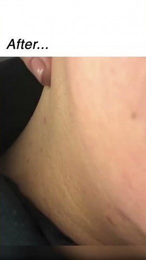 Skin tag removal before & afters // Amazon MUST HAVE!