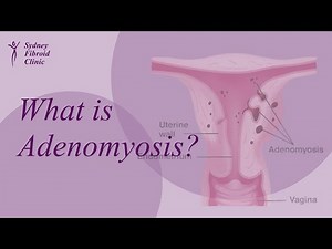 Adenomyosis Explained: Symptoms, Causes and Treatment Options Including UAE
