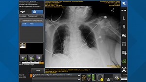 University Hospitals to begin using artificial intelligence to intubate COVID-19 patients
