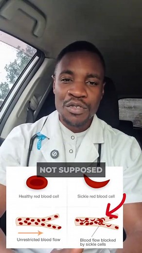 Understanding Sickle Cell Anemia: Key Facts and Insights