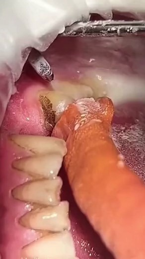 Tough stains can be removed w/ AIR ABRASION 💨🧽! A gentle stream of air, combined w/ very fine abrasive particles of silica & aluminum oxide (common ingredient in toothpaste) is used to remove the stains. #dentist #teeth #tooth #education