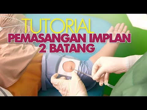 TUTORIAL PEMASANGAN IMPLAN 2 BATANG