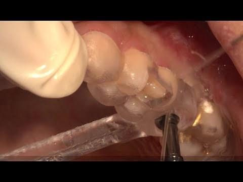 Flapless surgery with Tissue Punch