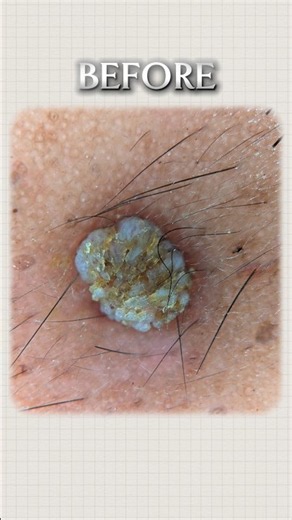 Dermatologist removing scarless painless wart in the face #chennaidermatologist #haircare