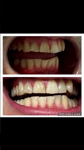 ✨ Before & After: Professional Laser Teeth Whitening in 1 Hour! 🦷🔥