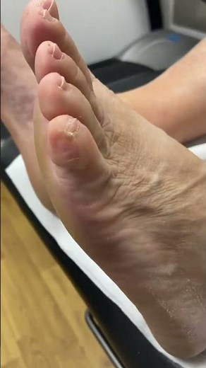 Painful Corn Removal on Little Toe by Australian Podiatrist | Effective Solutions for Callus & Corn