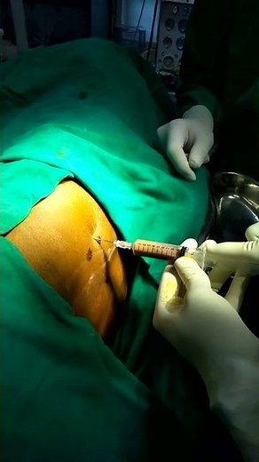 Psoas abscess drainage on left side. Tuberculosis of spine. Aspiration done with a spinal needle.