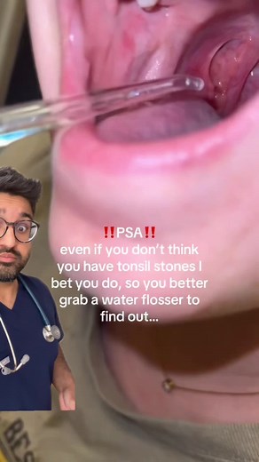 Can you remove tonsil stones with a water flosser? #health #gross #tonsils #tonsilstones #waterflosser #badbreath