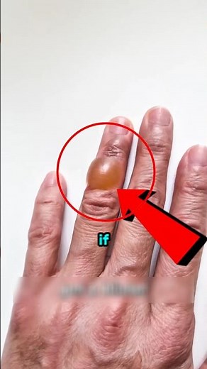 The Truth About Popping Blisters (Most People Do This Wrong)