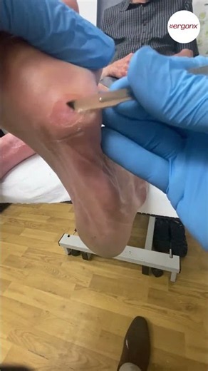 Say goodbye to foot discomfort! 👟✨ Discover the ultimate tips for removing and treating corns on