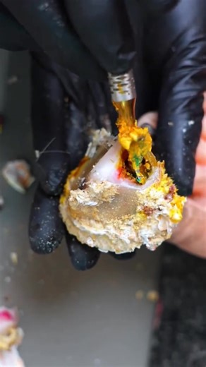 Ingrown Toenail Removal Treatment | Step-by-Step Cleaning Process | CTH F1