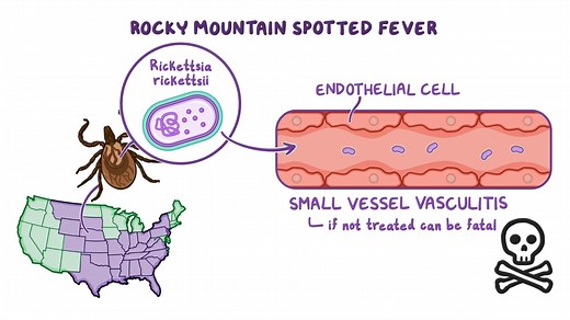Video: Rocky Mountain spotted fever (RMSF): Nursing - Video Explanation! | Osmosis | Osmosis