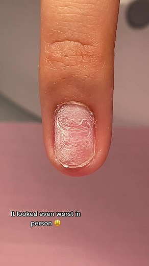 Unusual Nail Damage - A Nail Horror Story