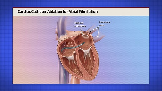 12K views · 179 reactions | Video Abstract: In the CABANA randomized...