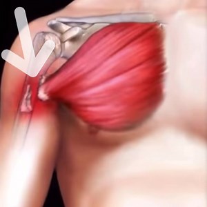 16K views · 177 reactions | Scans confirm a pec rupture for Tom Trbojevic that will require surgery (via SMH). He knew on-field: “I’ve torn my pec” Usual return to play time of 10-14 weeks means his season is all but over. Feel for Turbo with such a horrible run of injury, wish him the best with recovery ahead. | NRL Physio | Facebook