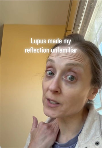 Confronting Lupus: A Journey of Reflection
