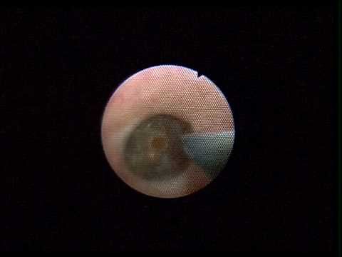 Ureteroscopic removal of kidney stone.