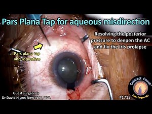 CataractCoach™1713: pars plana tap for aqueous misdirection