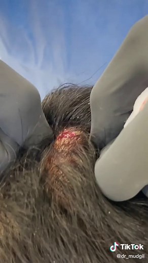 #pimplepopper #pimplepopping #cyst #drmudgil