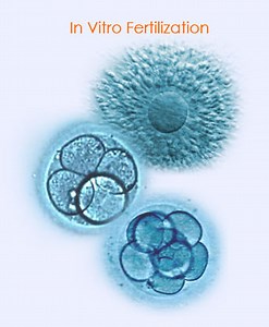 IVF - In Vitro Fertilization