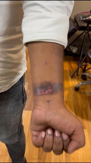 Burn Scar Cover-Up Tattoo Transformation | Mountain & Forest Tattoo Design 🔥⛰️🌲 #tattoo
