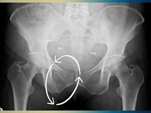 Pubic rami fracture