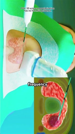 Thyroid radiofrequency ablation 3D Animation
