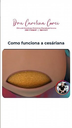 🤰 Como Funciona a Cesariana?