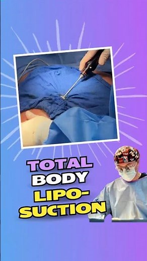 Total Body Liposuction With VASER Technology | Sculpt the Midsection, Thighs & Arms With Precision