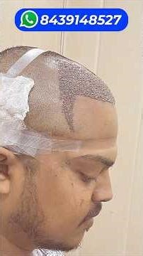 My Total Cost Of Hair Transplant Surgery To Result 🔥🔥🔥 #hairtransplantcost