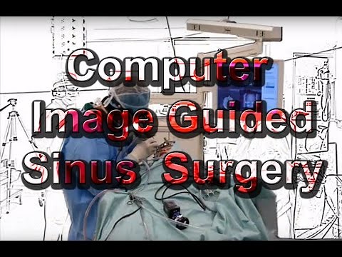 Image Guided Sinus Surgery, Computer Navigation, for sinus surgery