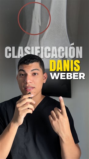 Dr. Bryam Vargas | Educación médica | 📚Clasificación de Danis-Weber, para fracturas de tobillo🦶🏼 Aún sigue siendo esencial en la teoría de estas lesiones y está presente en... | Instagram