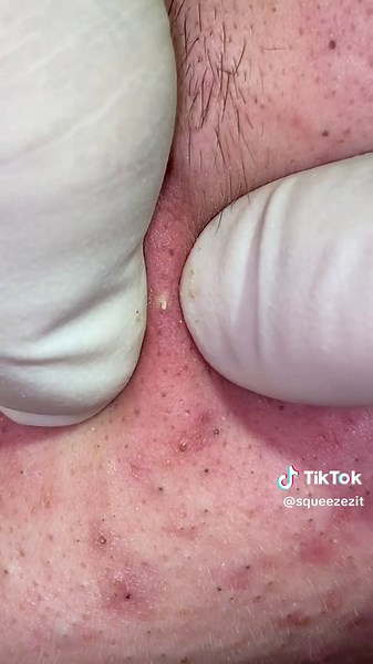 Watch 👀 til the end… #donttrythisathome #whitehead #pimplepop #zithappens #acne #skintok #beauty #blackheadextraction #cyst #jeragat #oilyskin #skincare #pimplelife #squeezezit
